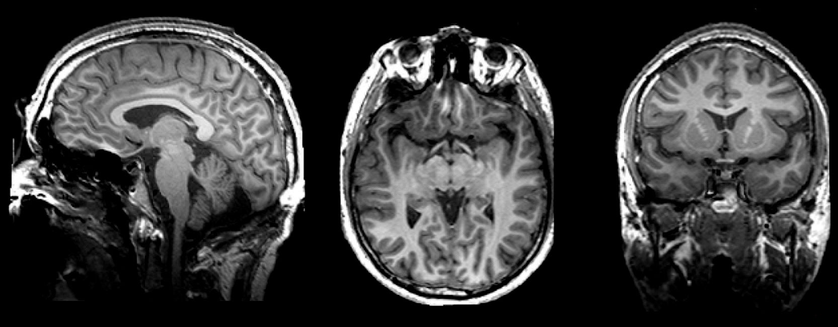 MRIs of the brain